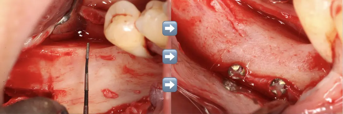 A bone reconstruction case, before and after