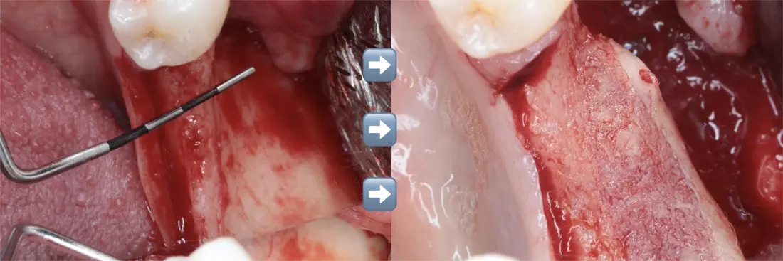 A bone graft case, before and after