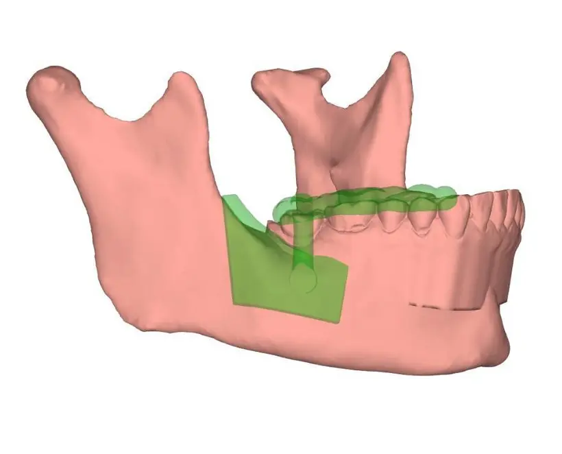 A step of the Guided Bone Harvesting protocol, planned digitally