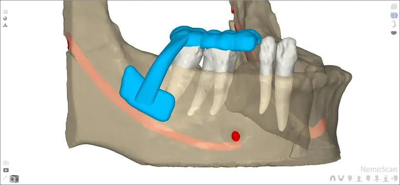 A step of the Guided Bone Harvesting protocol, planned digitally