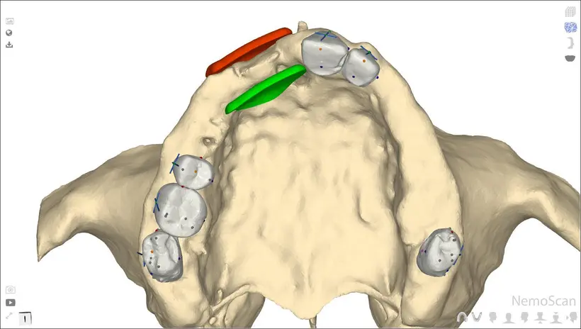 A step of the Guided Bone Harvesting protocol, planned digitally
