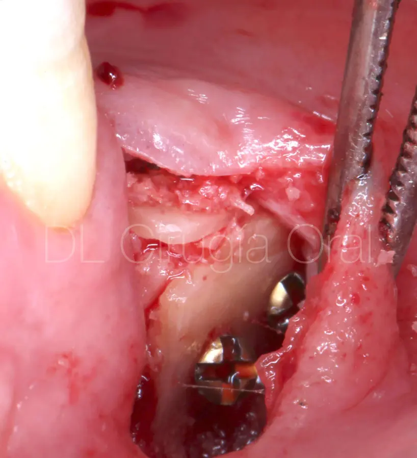 A vertical bone augmentation case