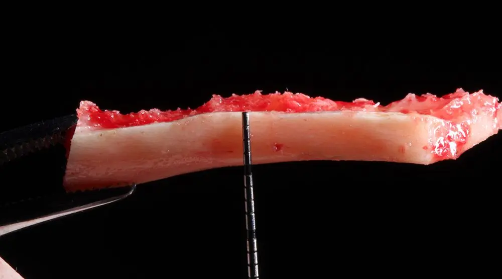 Building real bone with the Khoury Technique
