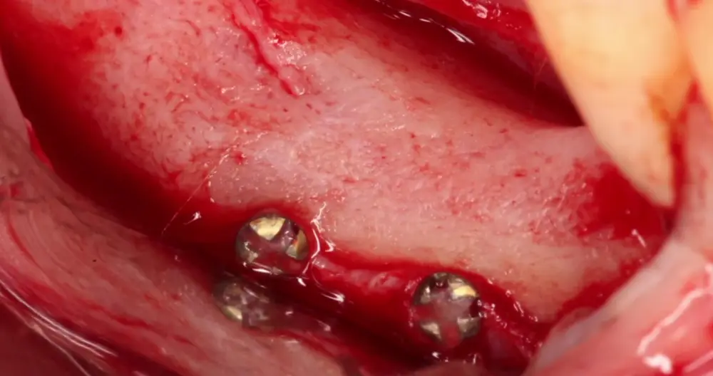 Bone augmentation with the Khoury technique