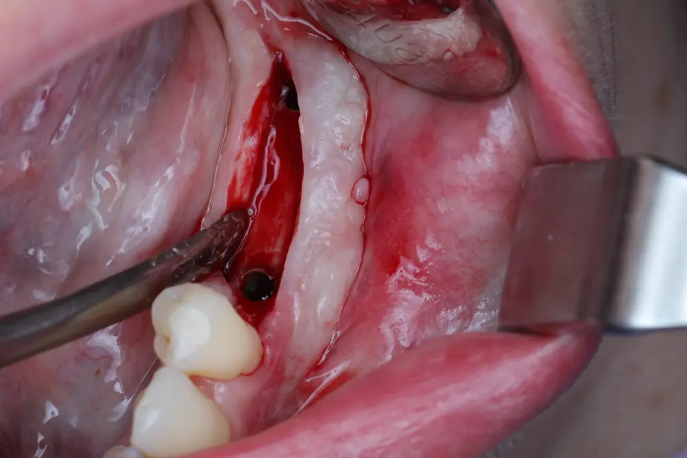 A bone reconstruction training session in the USA