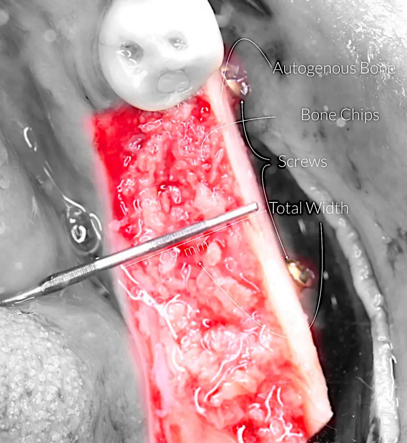 Horizontal bone augmentation