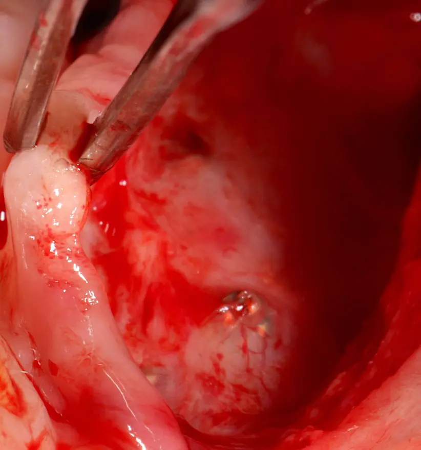 Soft tissue management in bone reconstruction