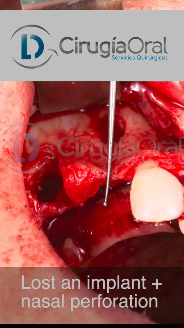 A bone reconstruction case — video still